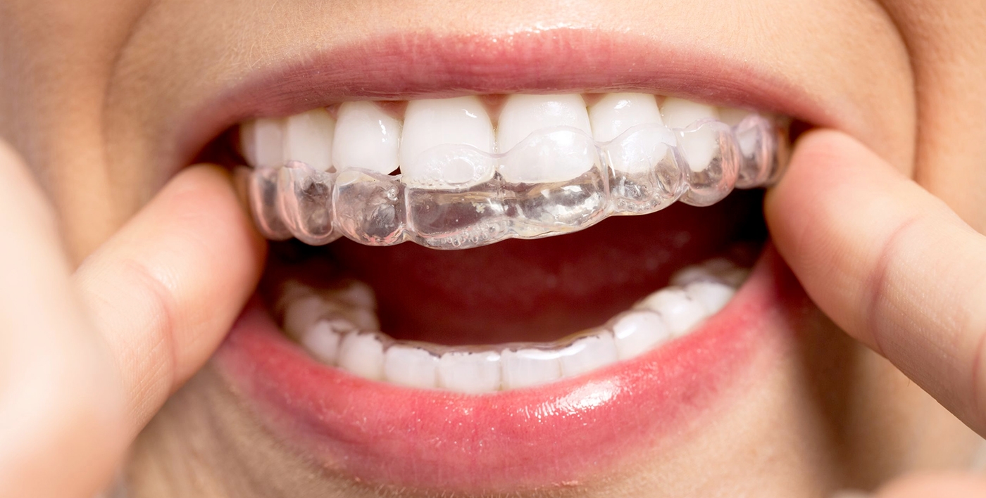 woman with invisalign in mouth